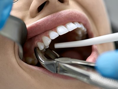 Tooth Extractions Pembroke Pines | Emergency Dentist | Friedland Family  Dentistry of Pembroke Pines